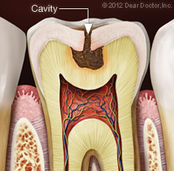 Anatomy of a tooth with a cavity 