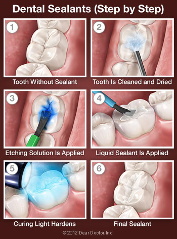 Step-by-step of dental sealants procedure