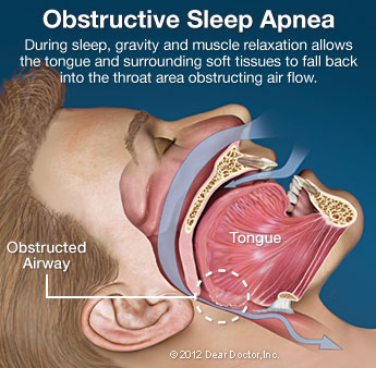 Obstrucive sleep apnea with obstructed airway