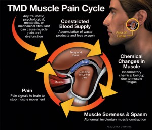 TMJ pain cycle illustration