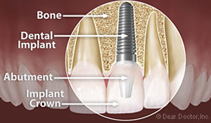 Anatomy of a dental implant at Baton Rouge dentist