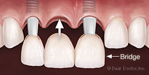 three unit dental bridge insertion from Baton Rouge dentist