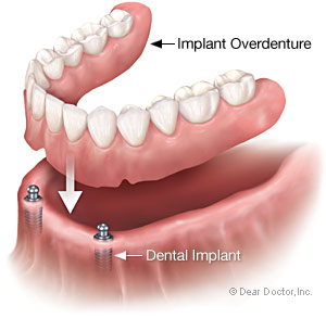 Implant overdenture supported by dental implant from Baton Rouge dentist