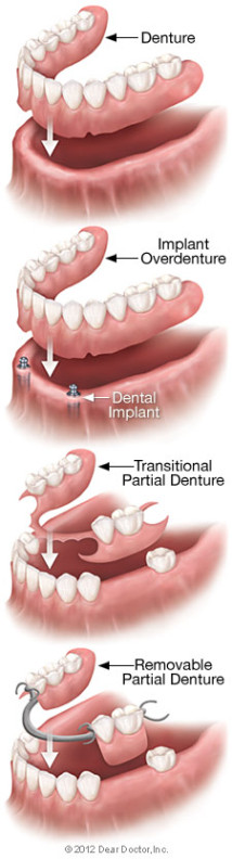  Full conventional dentures, overdentures, and partial dentures