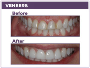 Before and after photos of veneers