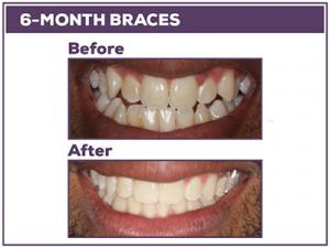 Before-and-After-6-month-braces-in-Baton-Rouge 