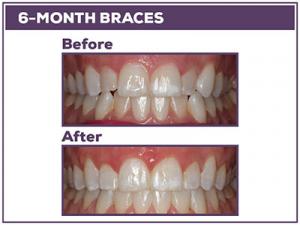 Before-and-After-6-month-braces-in-Baton-Rouge WEBB